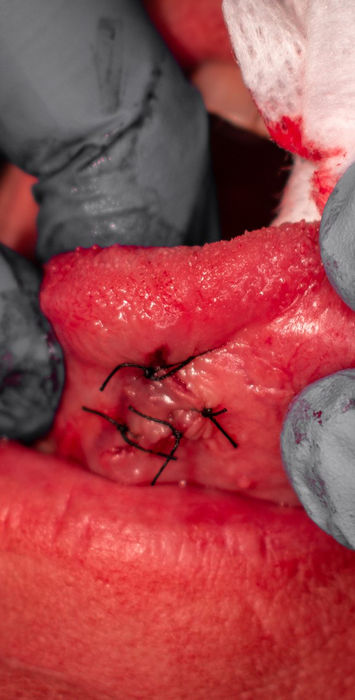 The small surgical site on the underside of the tongue closed with sutures after the mucocele was removed.