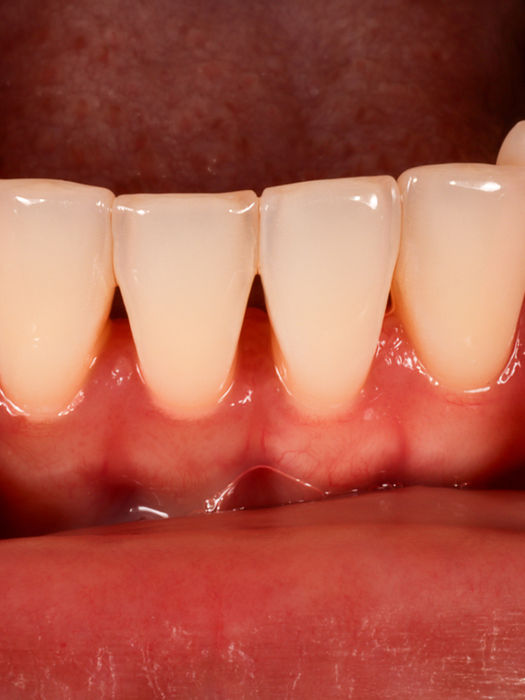 Bioclear black triangle closure before and after in Maspeth Queens