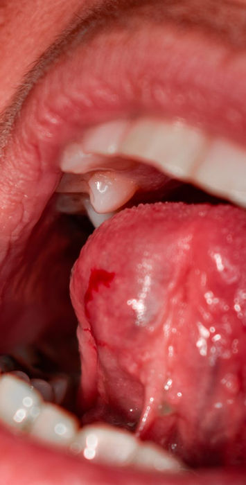 A mucocele — a soft, dome-shaped salivary-gland cyst — on the underside of the tongue, before removal.