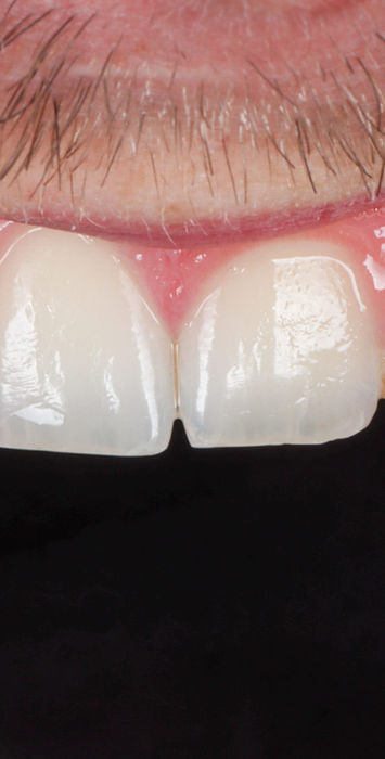 Composite veneer treatment for small laterals in Maspeth Queens