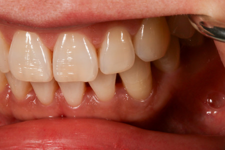 Bioclear black triangle closure at SOL Dental Arts, Maspeth Queens — case photo 3