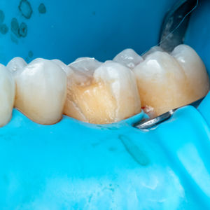 Partial Coverage Crowns (Onlays/Inlays) | SOL Dental Arts Maspeth Queens