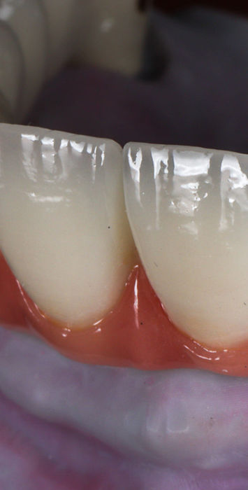 All-on-X implant-supported full arch restoration close-up in Maspeth Queens