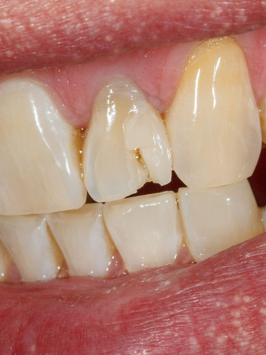 Emergency composite veneer before and after — cosmetic dentistry case at SOL Dental Arts in Maspeth, Queens