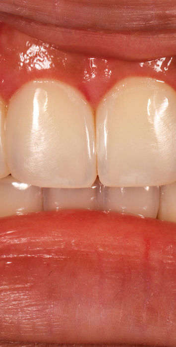 After Bioclear black triangle closure showing fuller smile contours