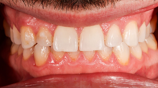 Peg lateral treatment after braces at SOL Dental Arts, Maspeth Queens — case photo 4