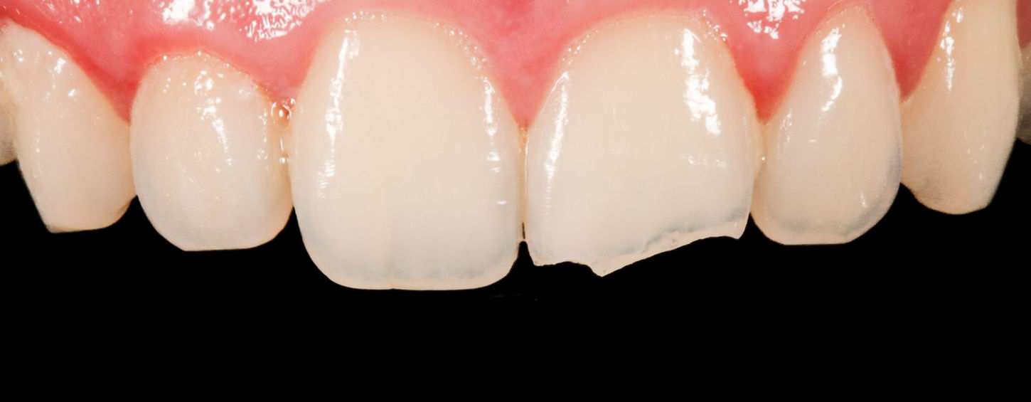 Before treatment, close-up: the upper left central incisor with an oblique fracture of its biting edge near the midline.