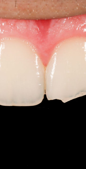Before treatment, close-up: the upper left central incisor with an oblique fracture of its biting edge near the midline.