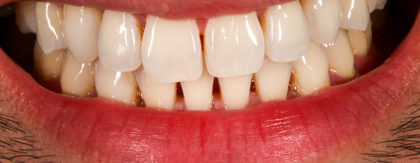 Close-up before Bioclear bonding for visible spaces between front teeth