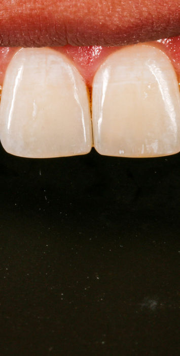 Completed chipped front teeth composite bonding case at SOL Dental Arts