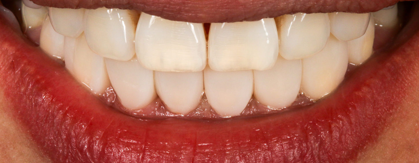 Final smile detail after Bioclear black triangle space closure