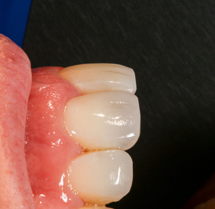 Close-up of polished composite bonding on upper front teeth.