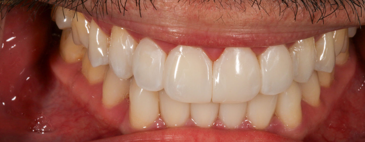 Bioclear composite treatment photo with improved anterior tooth contours