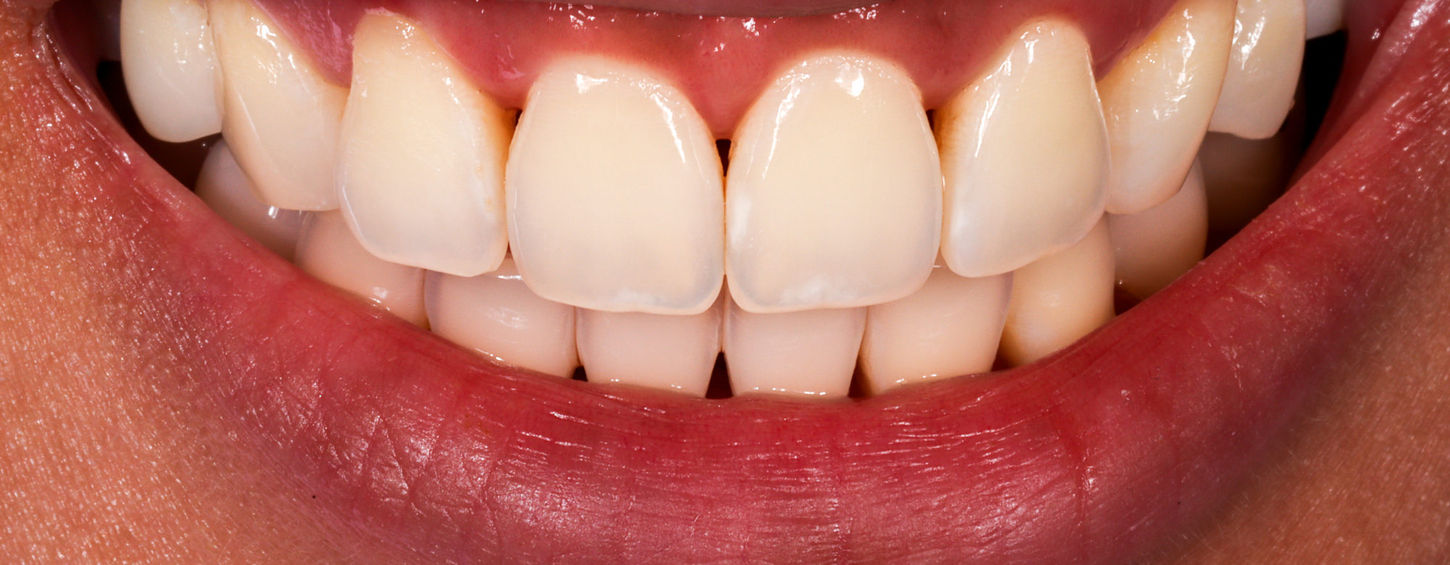 Before Bioclear black triangle closure showing dark spaces between front teeth in Maspeth Queens
