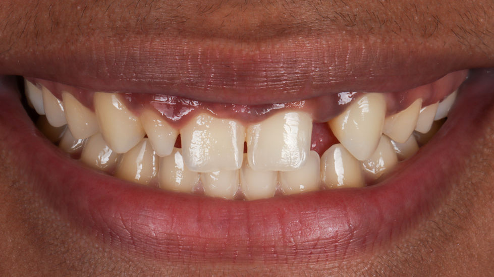 Peg lateral correction with cosmetic bonding in Maspeth, Queens