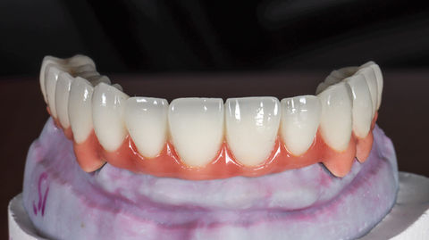 All-on-X full arch implant rehabilitation before-and-after gallery image