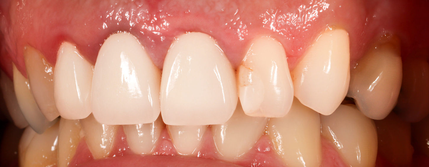 Pre-treatment view of worn lateral-incisor bonding before composite repair.