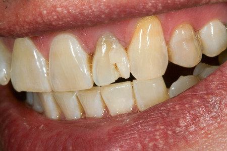 Emergency composite veneer treatment for a damaged front tooth at SOL Dental Arts, Maspeth Queens — case photo 5