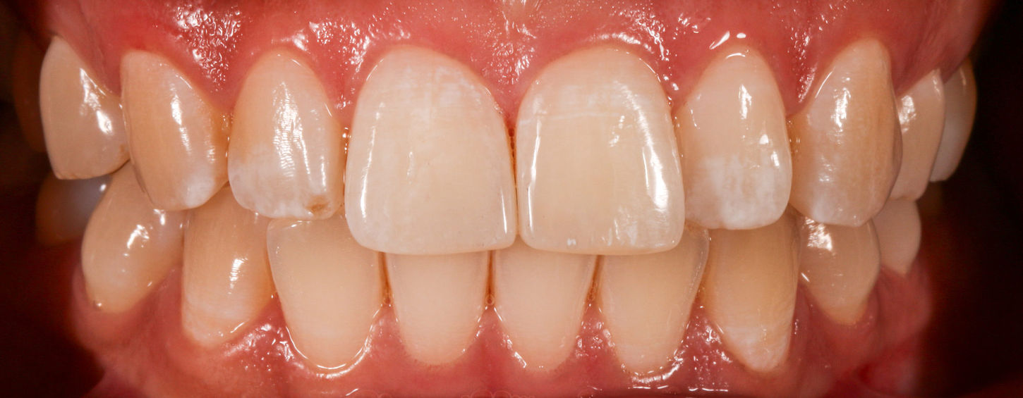 Additional after view of aesthetic composite bonding for chipped front teeth