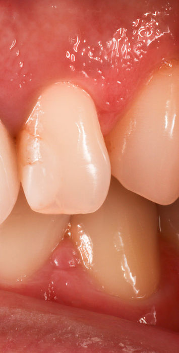 After view of lateral incisor bonding replaced with a polished composite restoration.