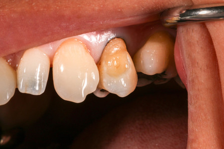 Cervical lesion treatment at SOL Dental Arts, Maspeth Queens — case photo 1