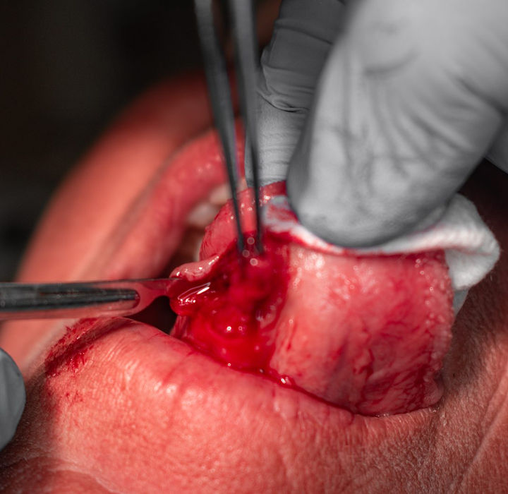 The mucocele on the underside of the tongue being removed with fine instruments during a minor in-office surgical procedure.