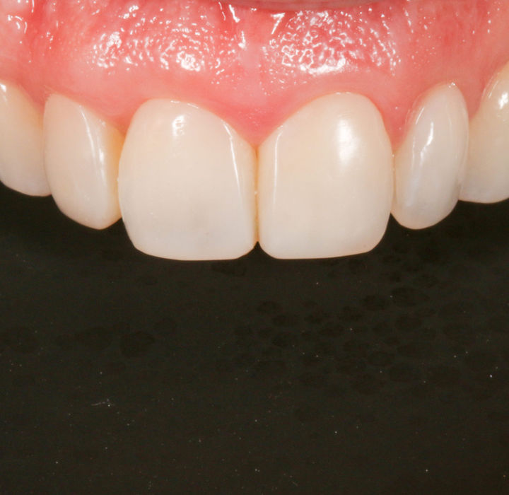Final image of cosmetic bonding for front-tooth symmetry.