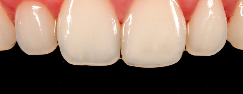 After smile photo showing front tooth chip blended after bonding