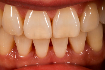 Bioclear black triangle closure at SOL Dental Arts, Maspeth Queens — case photo 1
