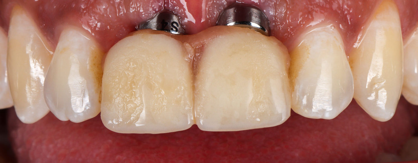 Close-up before implant crown placement showing space for tooth replacement