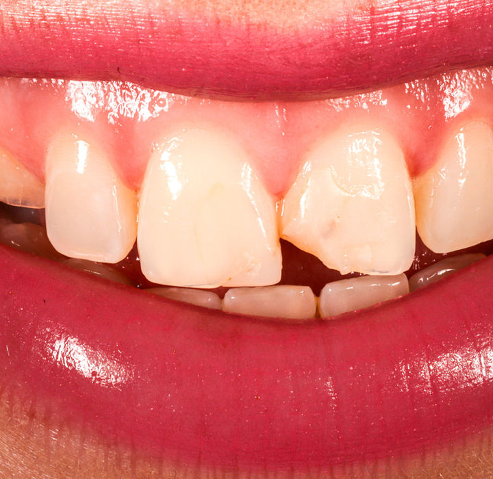 Before view of chipped tooth requiring multi-surface composite bonding repair