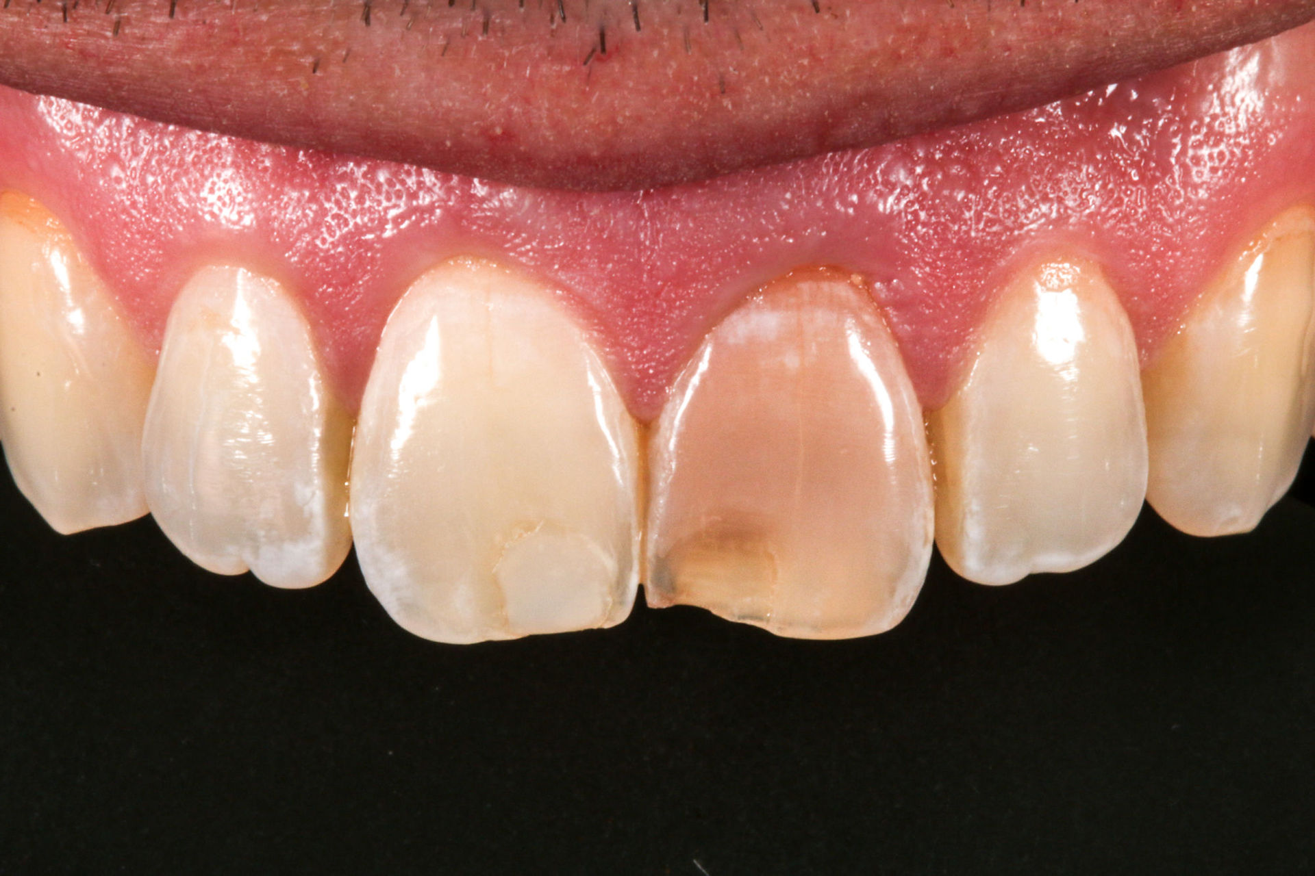 Dark central incisor treated with composite bonding at SOL Dental Arts, Maspeth Queens — case photo 2