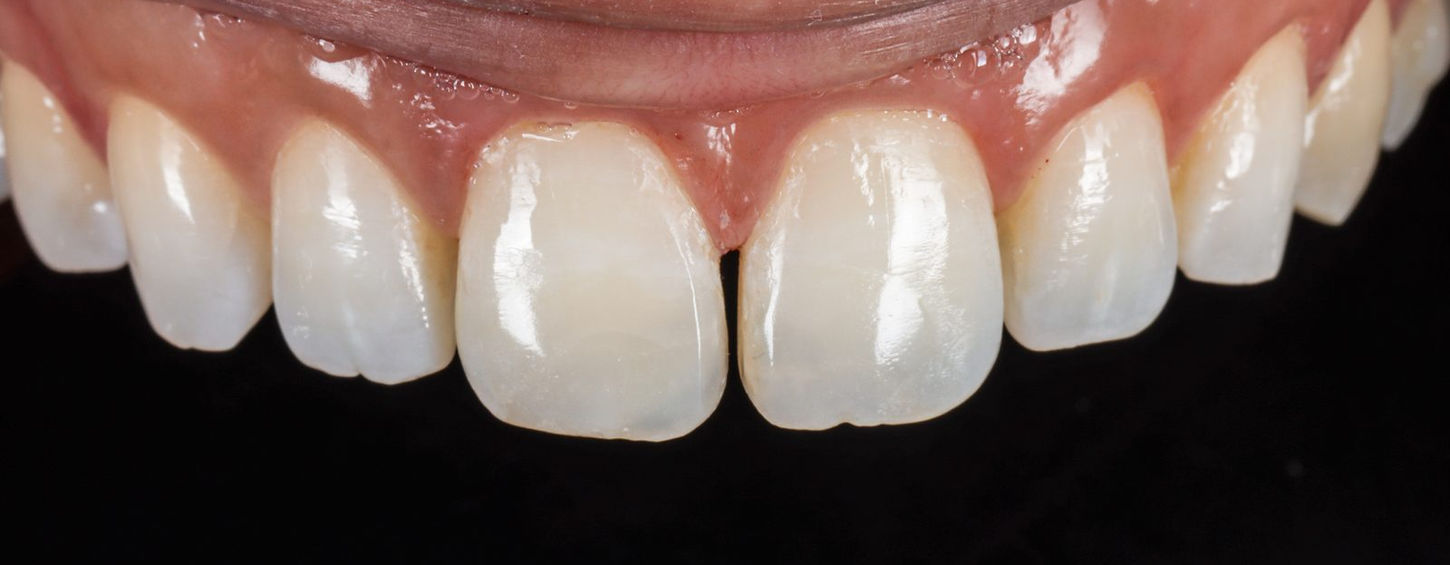 After: a clean, natural-looking midline diastema recreated between the central incisors with composite bonding.
