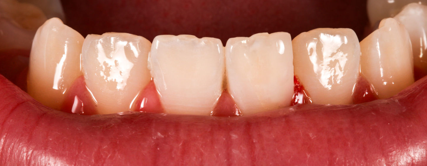Composite bonding repair on a chipped mandibular incisor during treatment planning.