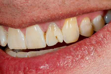 Emergency composite veneer treatment for a damaged front tooth at SOL Dental Arts, Maspeth Queens — case photo 3
