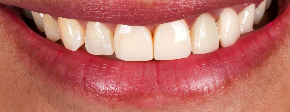 Veneers and whitening smile refinement at SOL Dental Arts, Maspeth Queens — case photo 6