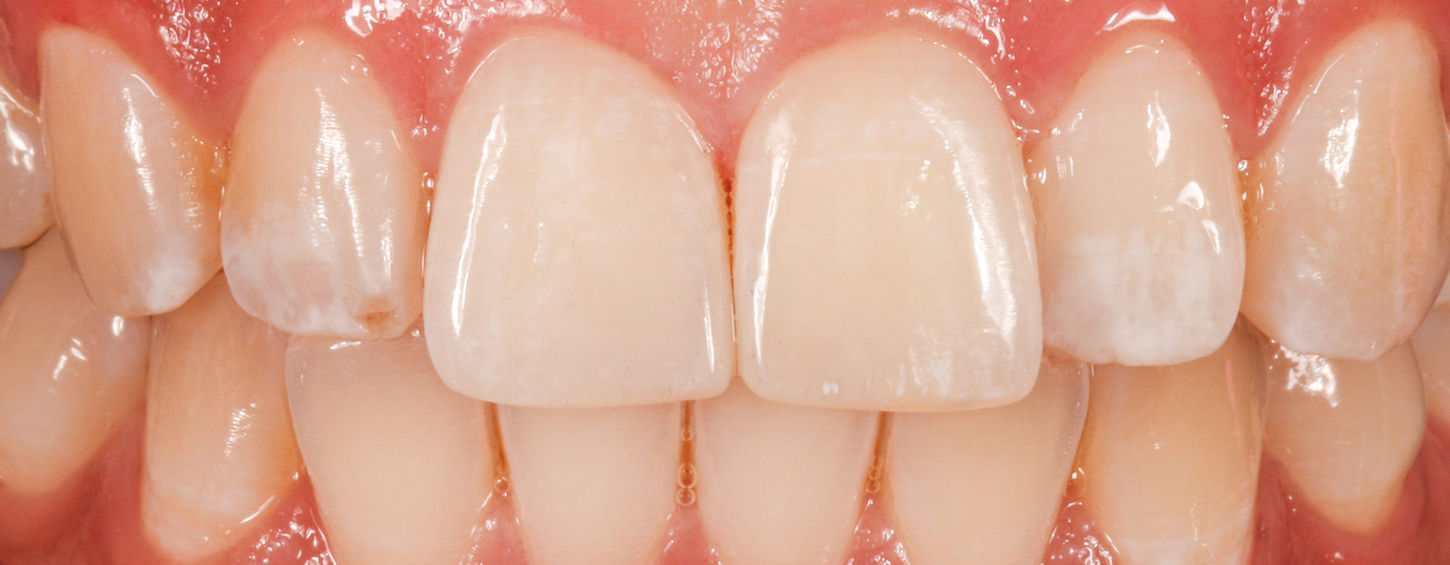 Treatment planning image for chipped front teeth composite bonding repair