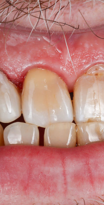 Traumatic fracture of maxillary lateral incisor restored with cosmetic bonding — before and after at SOL Dental Arts, Maspeth Queens