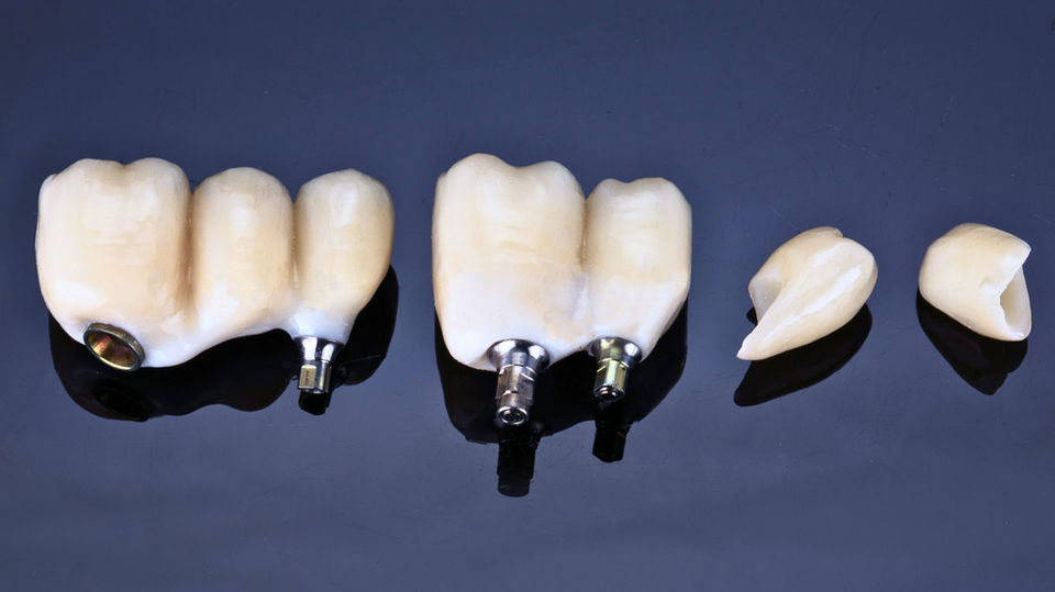 Dental implant restoration at SOL Dental Arts in Maspeth Queens
