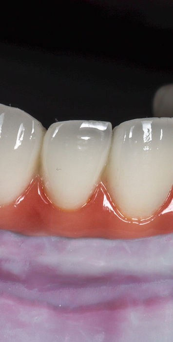 All-on-X full arch implant case documenting treatment progress