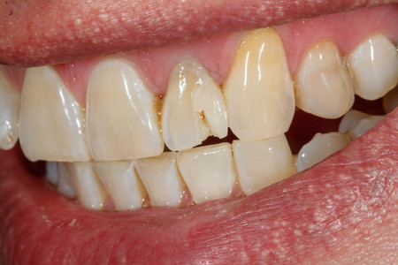 Emergency composite veneer treatment for a damaged front tooth at SOL Dental Arts, Maspeth Queens — case photo 6