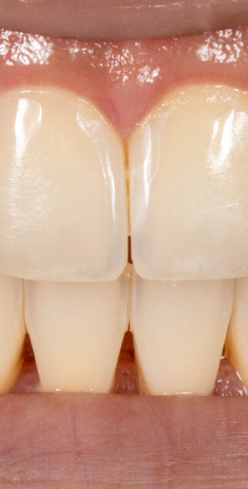 After photo of Bioclear space closure with polished composite contours