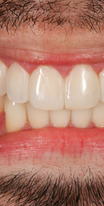 Bioclear composite bonding view with refined front-tooth emergence contours