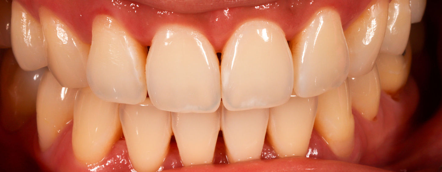 Pre-treatment smile view for Bioclear black triangle closure at SOL Dental Arts