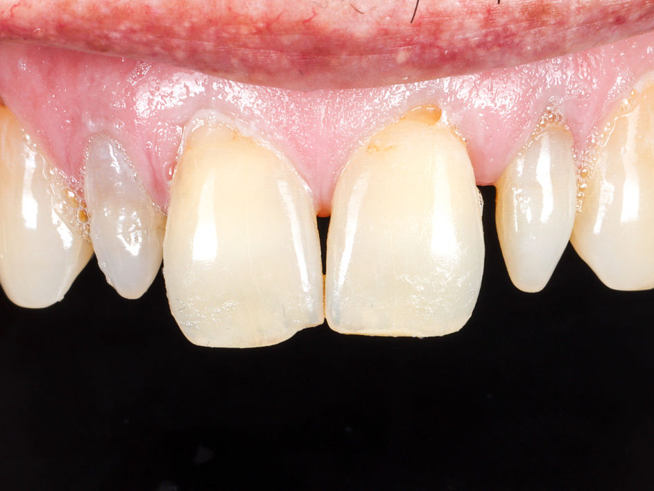 Ultrathin veneers for peg lateral teeth before and after in Maspeth Queens