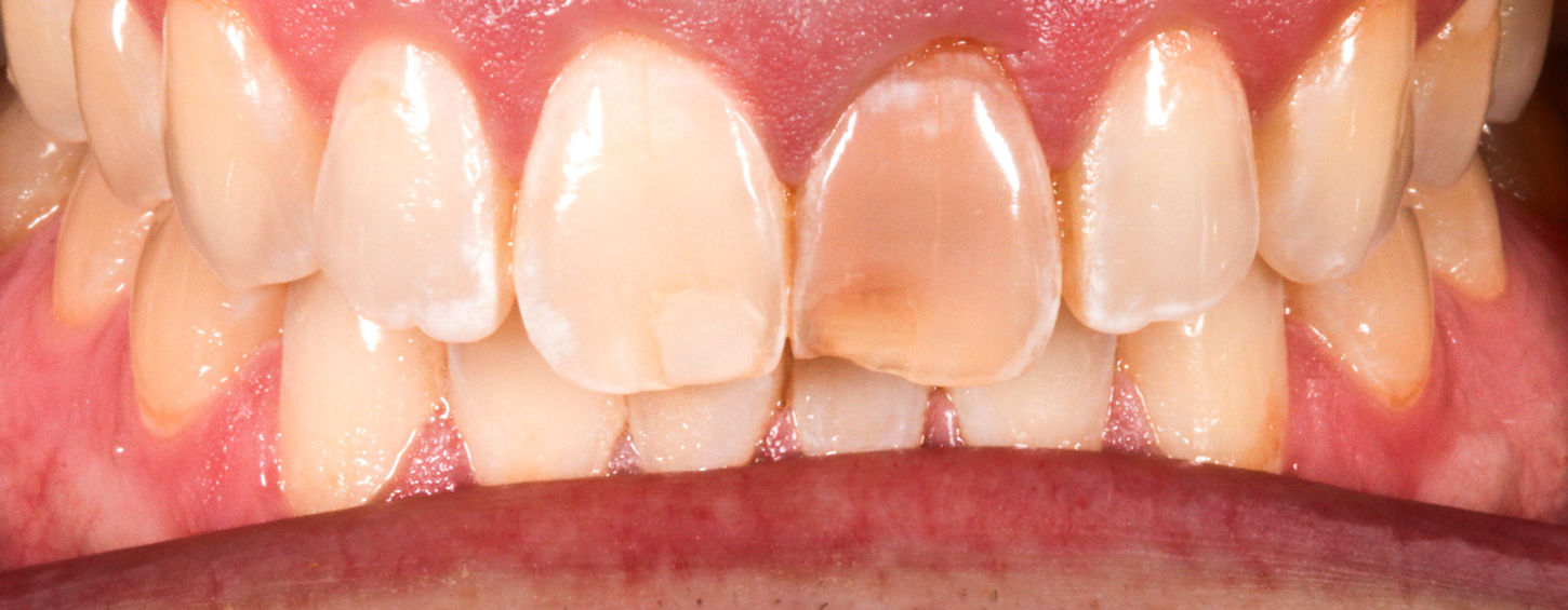 After composite bonding view of a dark central incisor blended with neighboring teeth