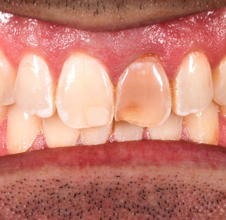 After composite bonding view of a dark central incisor blended with neighboring teeth