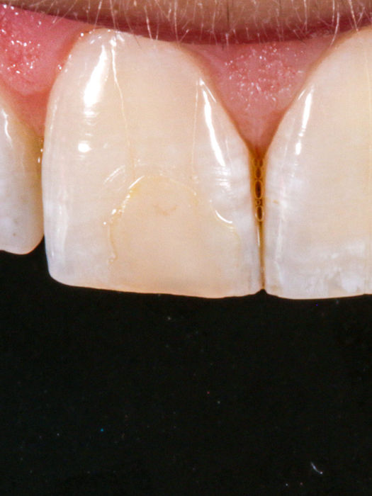 Failing bonding repaired and replaced before and after — cosmetic dentistry case at SOL Dental Arts in Maspeth, Queens