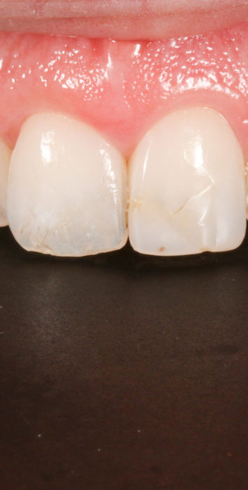 Close-up planning view for central and lateral incisor bonding in Maspeth, Queens.