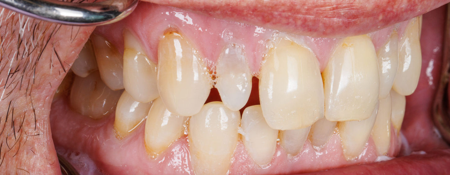 Ultra-thin composite veneer treatment view improving small lateral tooth proportions